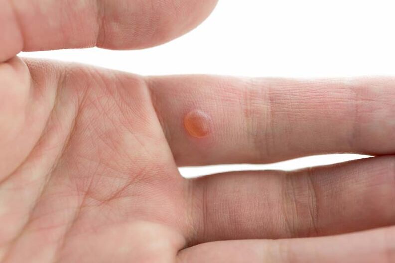 Unha verruga no dedo, que os remedios populares axudarán a desfacerse
