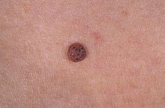 Papilloma procesado