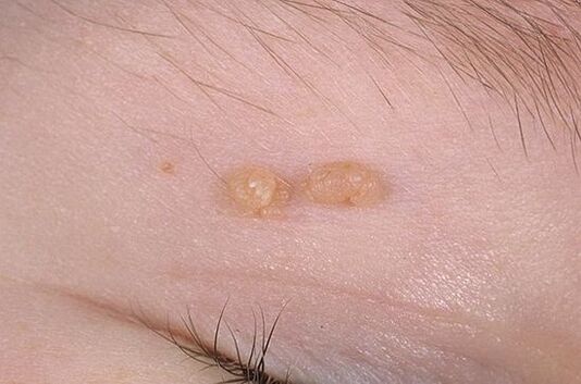 Papiloma ordinario