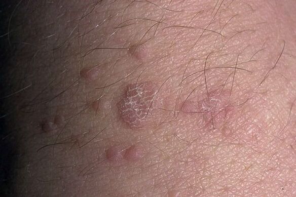 Papiloma plano
