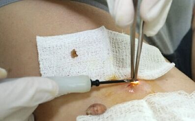 Tratamento cirúrxico do virus do papiloma humano