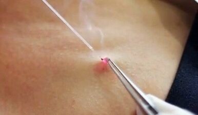 Eliminación do papiloma no corpo cun láser