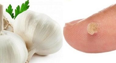 tratamento de verrugas con remedios populares