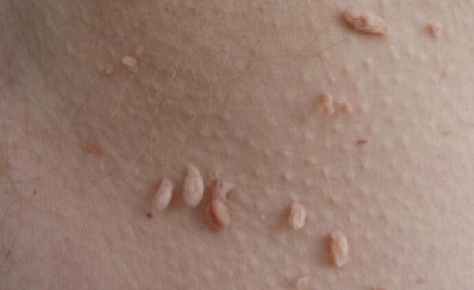 razóns para a aparición de papilomas no corpo humano