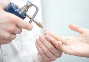 métodos modernos para eliminar papilomas