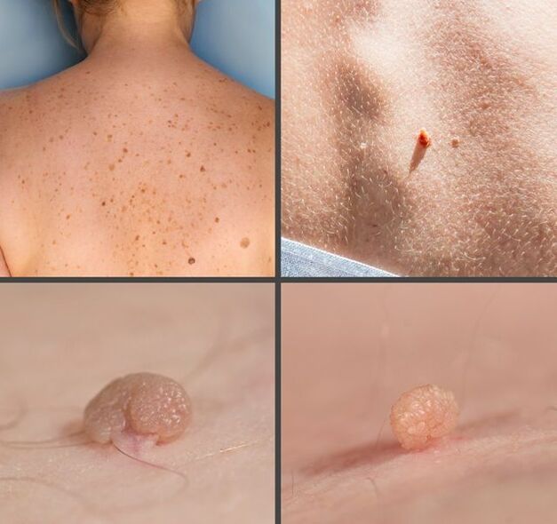 Como se ven os papilomas no corpo