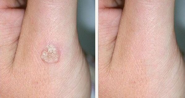 Fotos antes e despois da eliminación de verrugas usando remedios naturais